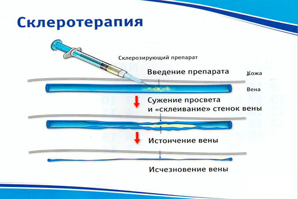 Компрессионная склеротерапия (микросклеротерапия)