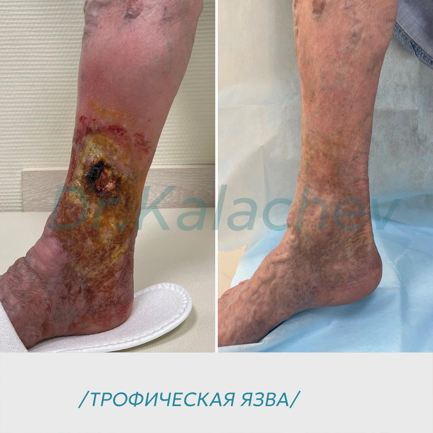 Лечение трофической язвы в Москве