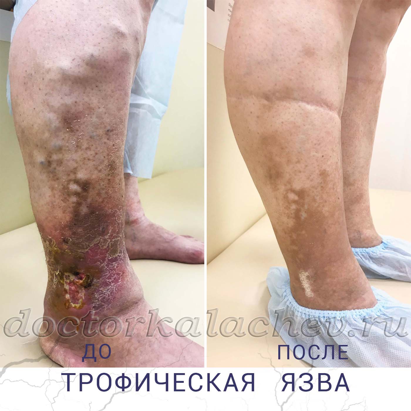 Лечение трофической язвы в Москве