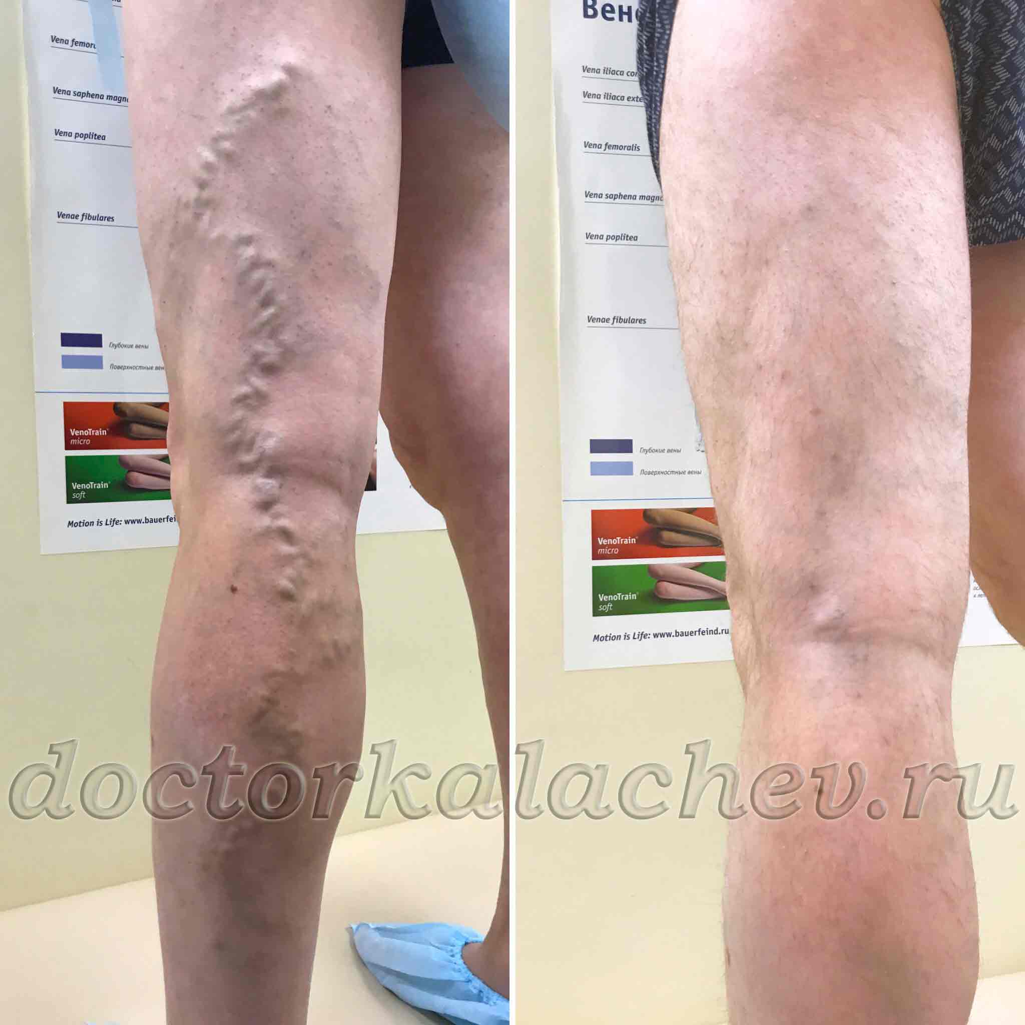 Минифлебэктомия