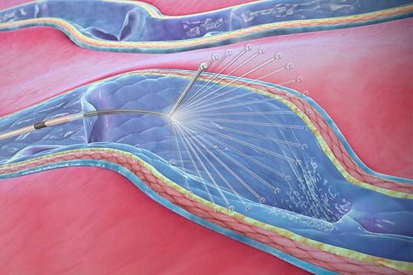 NTNT технологии в лечении варикоза и их реальное место в современной флебологии