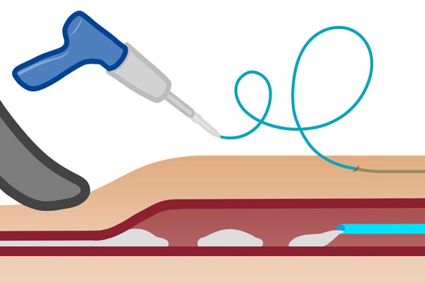 Клеевая облитерация варикозных вен: VenaSeal, клей Момент и другие технологии