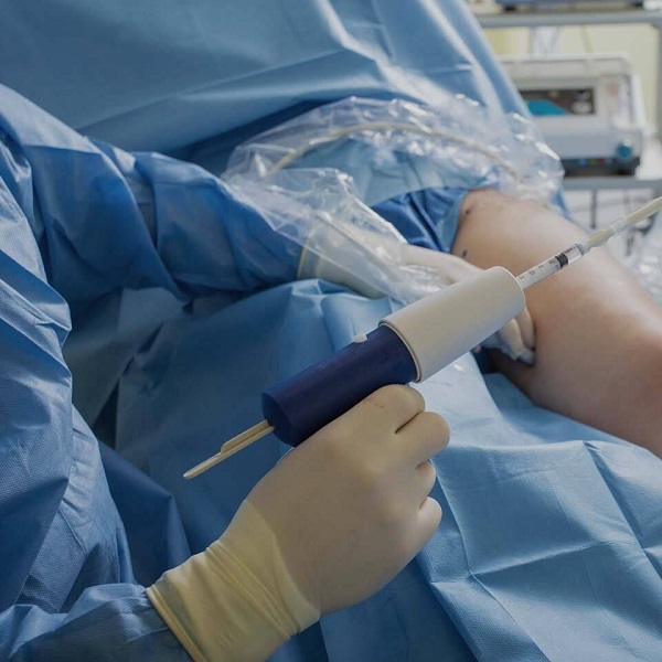 Клеевая облитерация варикозных вен: VenaSeal, клей Момент и другие технологии