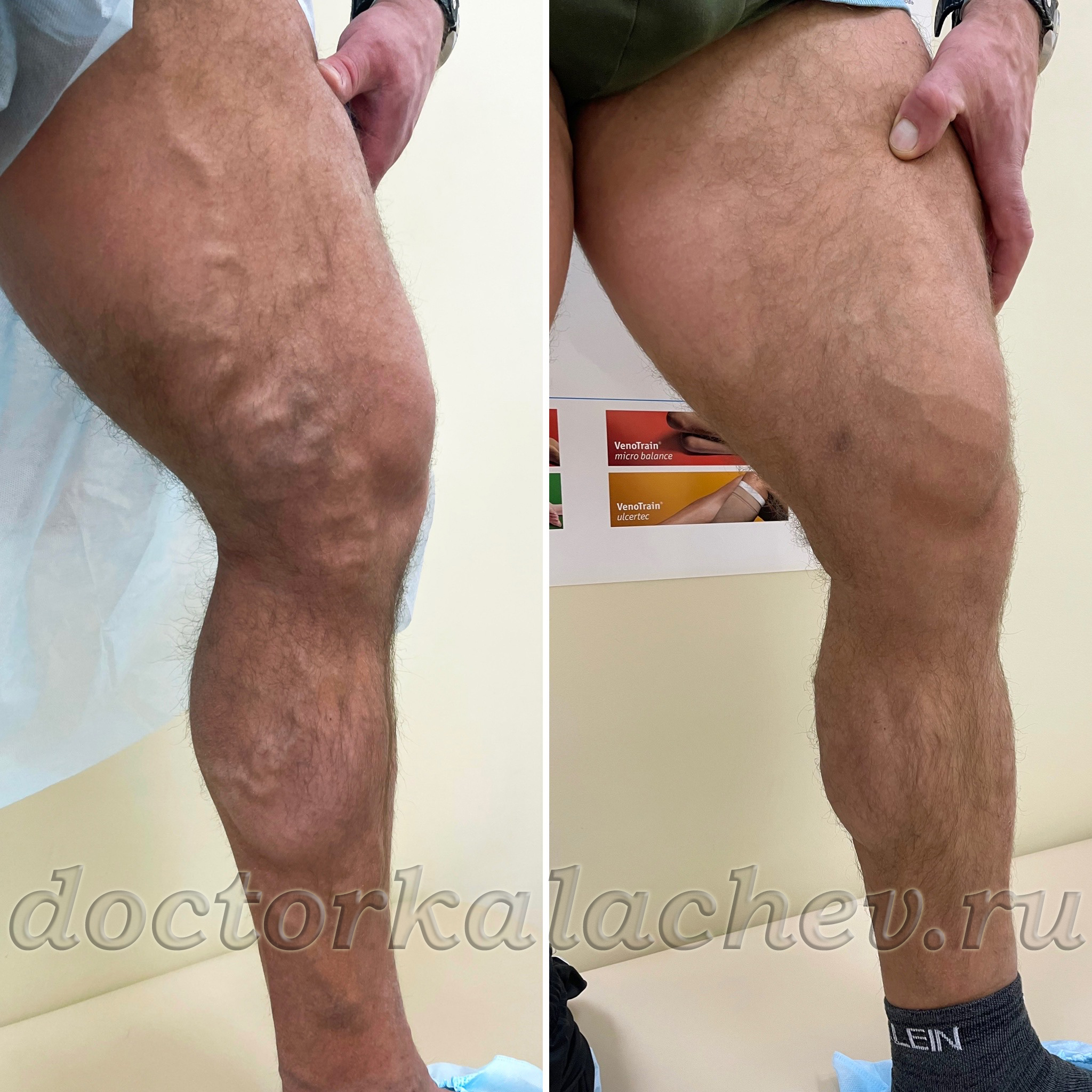 Тотальная ЭВЛК при варикозе. Пациент 42 лет — результат через 3 месяца.