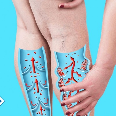 Осложнения варикоза: когда ситуация становится опасной