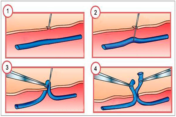 Минифлебэктомия вен нижних конечностей