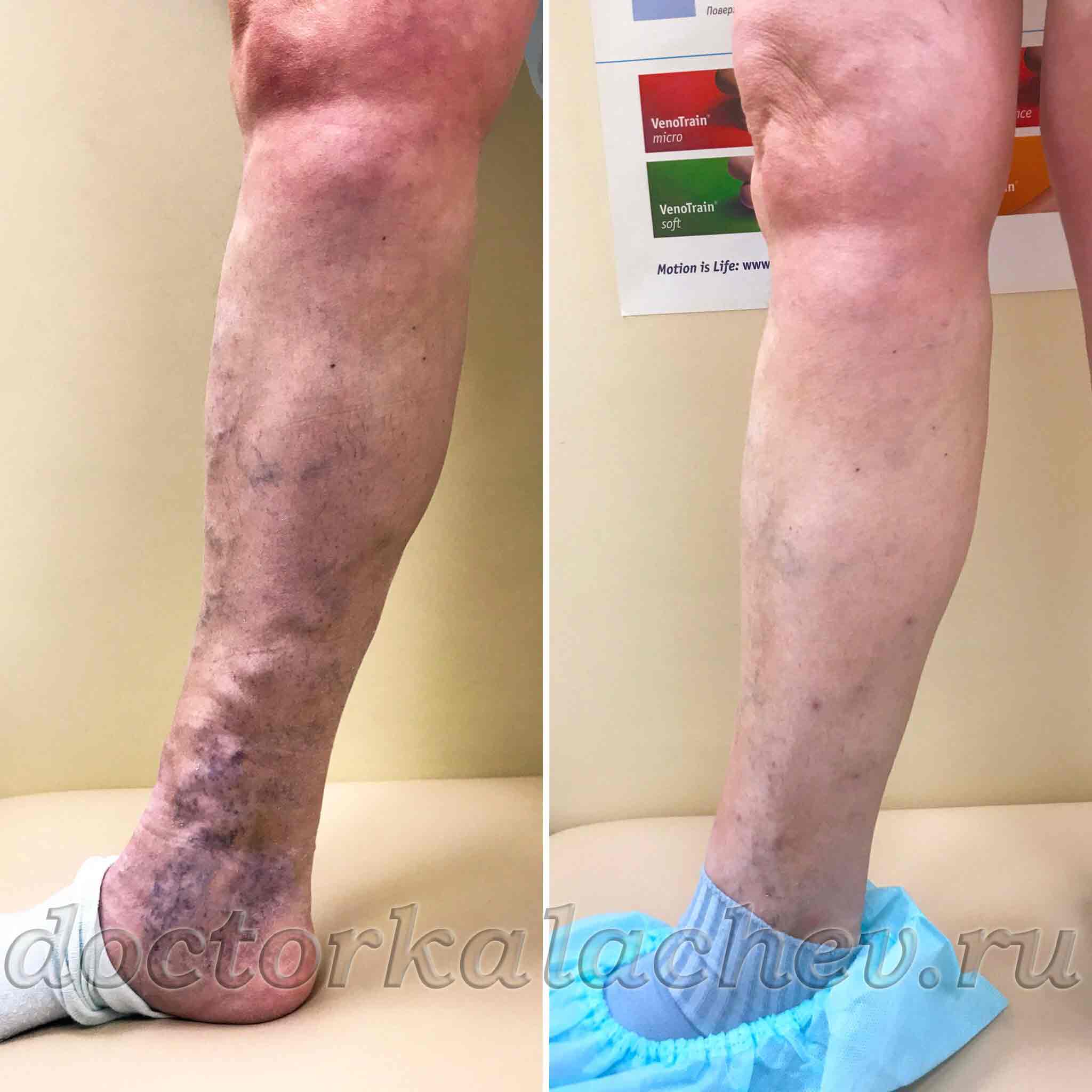 ЭВЛК при варикозе, осложненном трофическими нарушениями. Пациентка 63 лет — результат через полгода.
