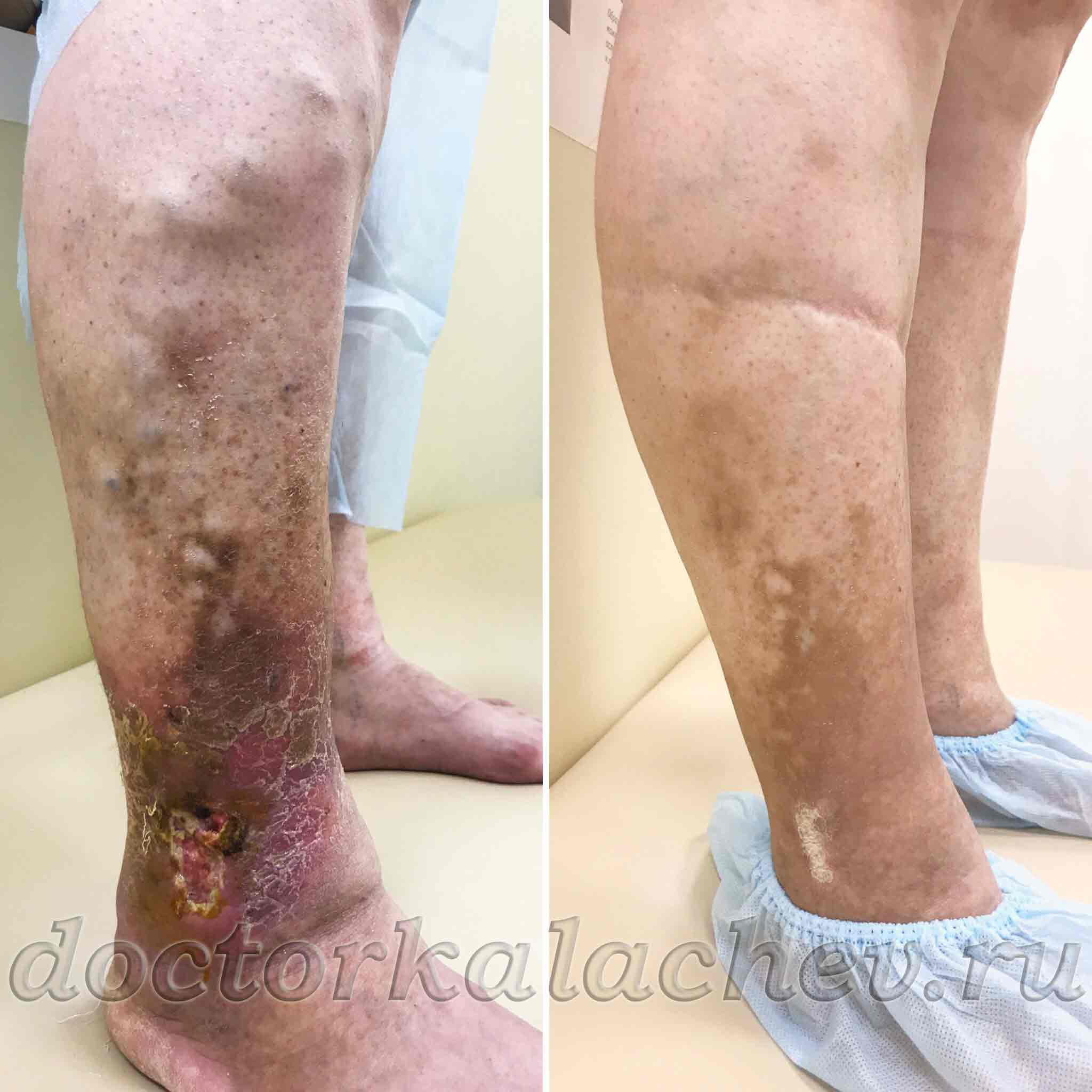 ЭВЛК при трофической венозной язве и рецидивирующих кровотечениях, осложнивших запущенный варикоз. Пациентка 52 лет — результат через 4 месяца.