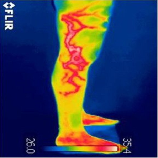 NTNT технологии в лечении варикоза и их реальное место в современной флебологии