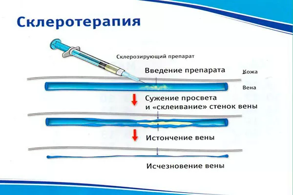 Компрессионная склеротерапия (микросклеротерапия)
